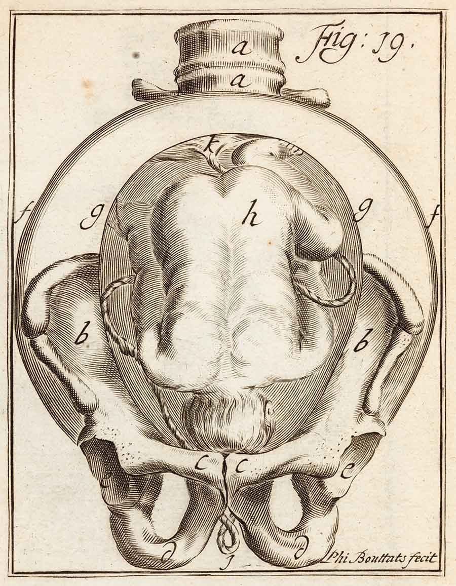 Illustration of a fetus in the womb in Hendrik van Deventer’s Operationes chirurgicae novum lumen exhibentes obstetricantibus, 1701.